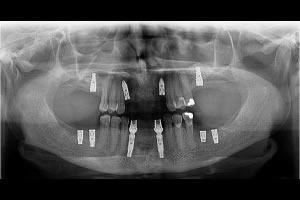 Tratamento com Implantes - Passo a Passo